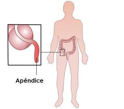 симптомы аппендицита какие боли