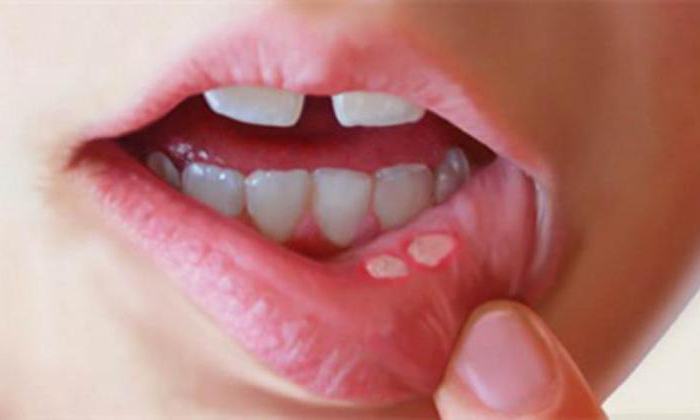 как отличить простуду на губе от сифилиса