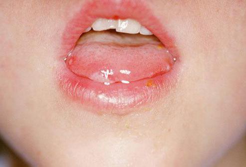 сифилис на губах