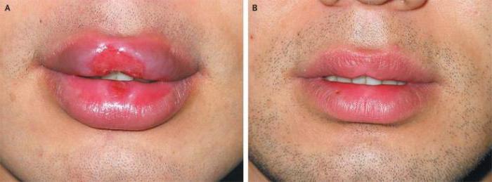 сифилис на губах какие анализы сдавать