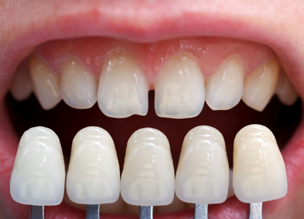 Щели между зубами как исправить?