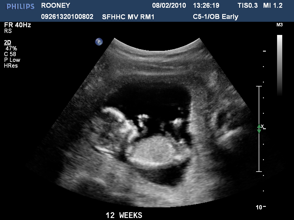 Диагноз 12 недель. 11 Недель беременности фото плода на УЗИ. УЗИ плода при беременности 12 недель. Как выглядит ребенок на УЗИ В 11 недель. УЗИ 11 недель беременности размер плода.