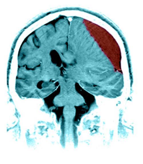 гематома головного мозга операция последствия