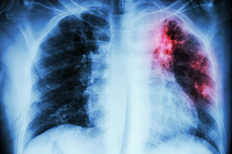 Признаки диффузного пневмосклероза легких