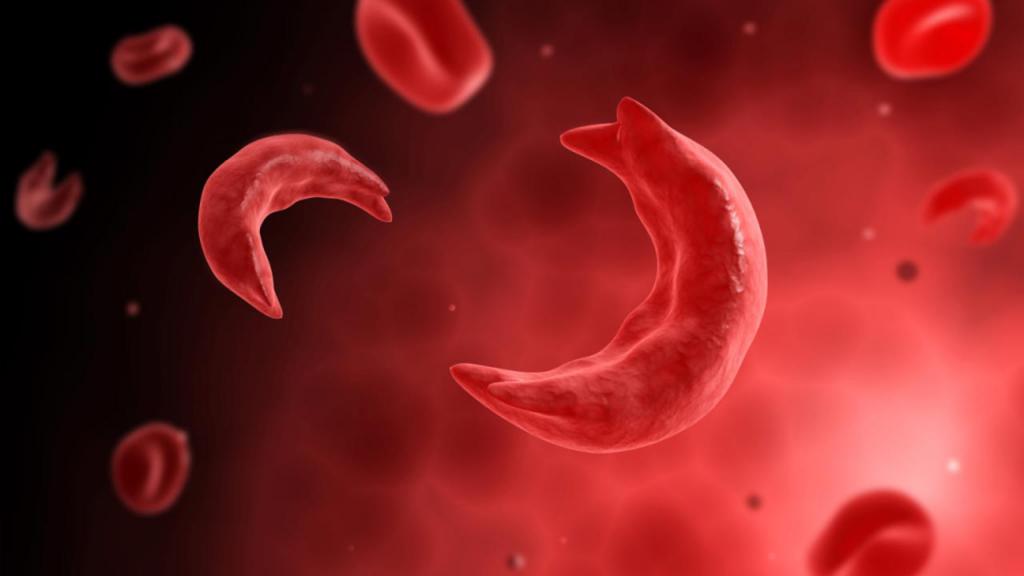 Эритроциты человека при серповидно-клеточной анемии