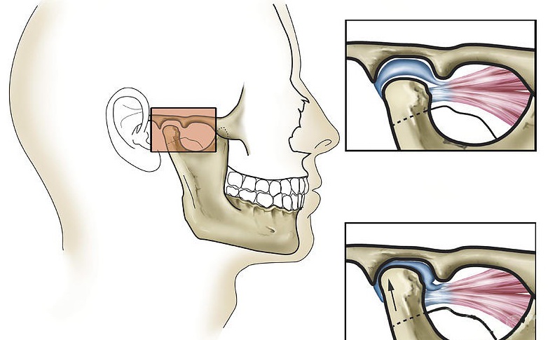Изображение - Нижнечелюстной сустав симптомы 2468511