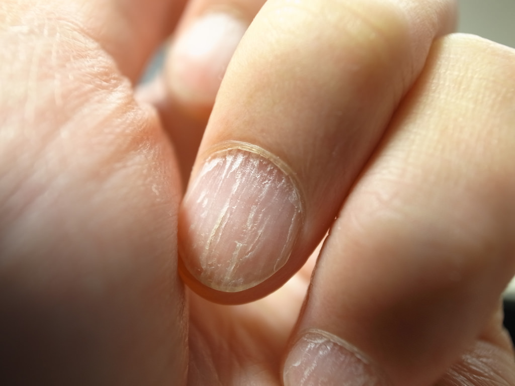 Витамины для волос и ногтей если ногти слоятся
