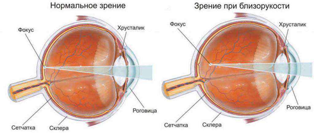 Зрение при норме и миопии