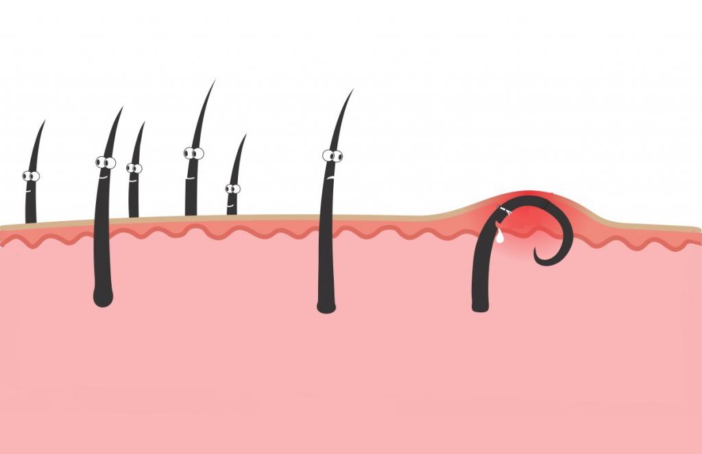 Как достать вросший волос если он глубоко. Причины появления вросших волос на ногах. Волосы врастают? Решение есть