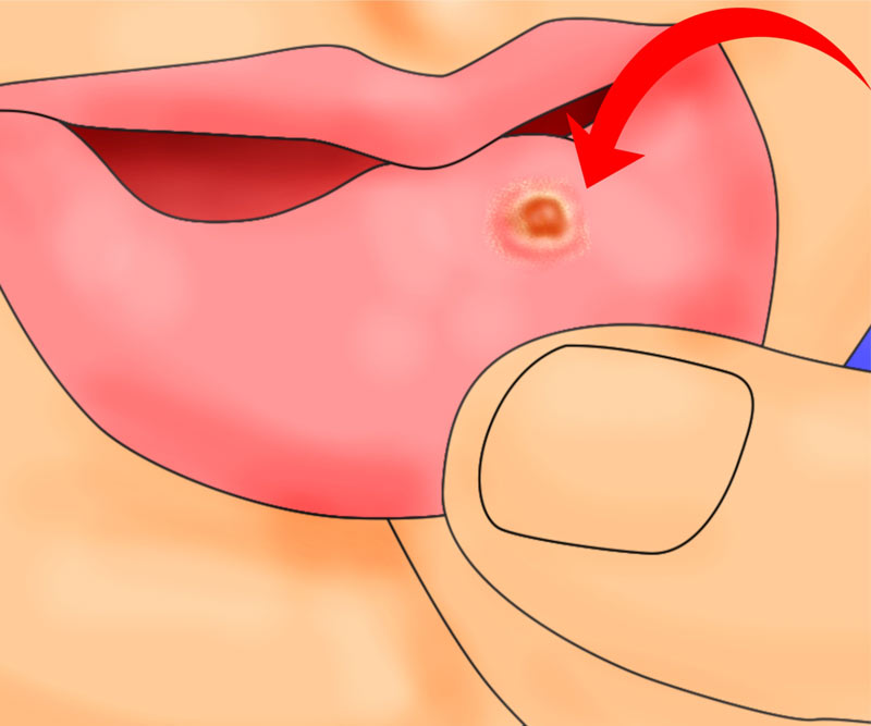 как лечить язвочки во рту