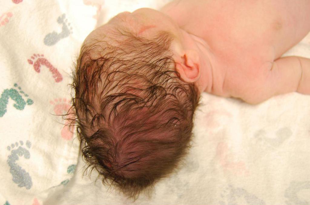 Форма головы новорожденного после нормальных родов