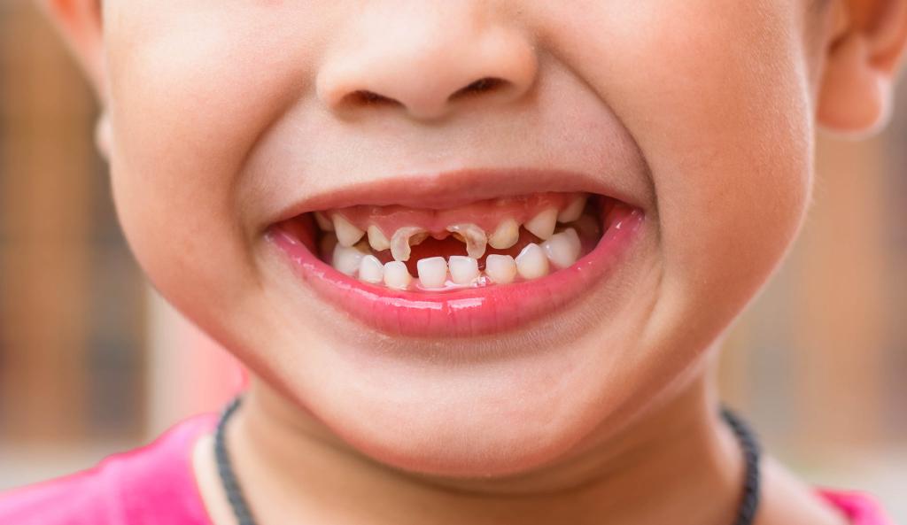 Реставрация зубов у детей