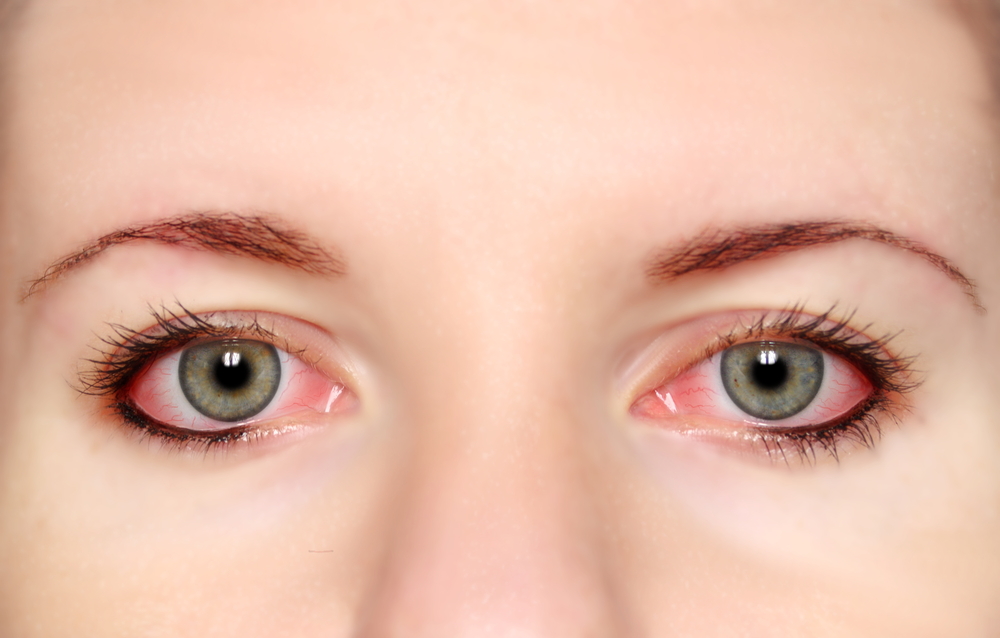 Как выглядят глаза если аллергия симптомы thumbnail