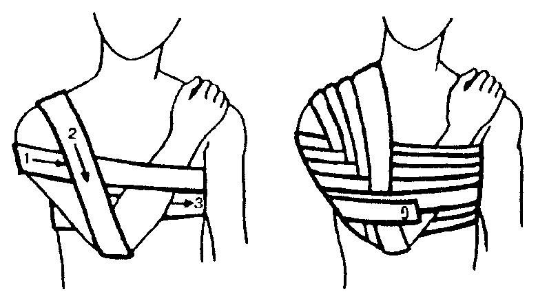 Как правильно наложить повязку Вельпо после травмы?