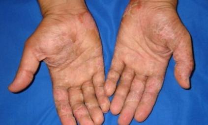 шелушение кожи на пальцах рук