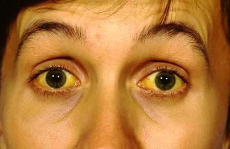 почему белки глаз желтые 