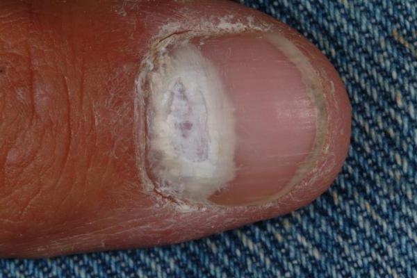 грибковые заболевания кожи рук