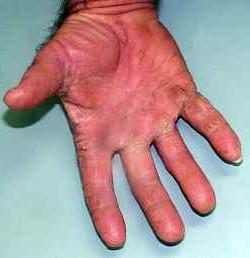 грибок между пальцев рук