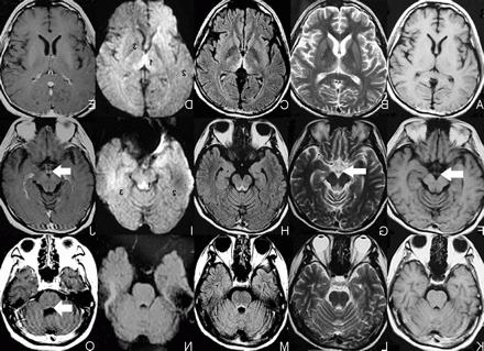 энцефалопатия головного мозга