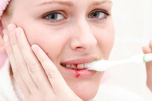 Кровоточат десны при чистке зубов
