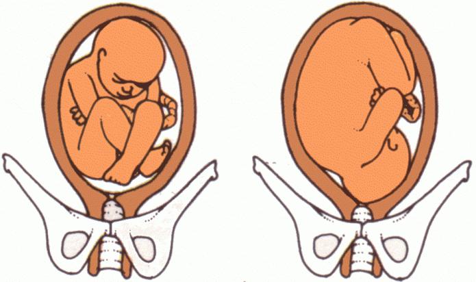 тазовое предлежание плода