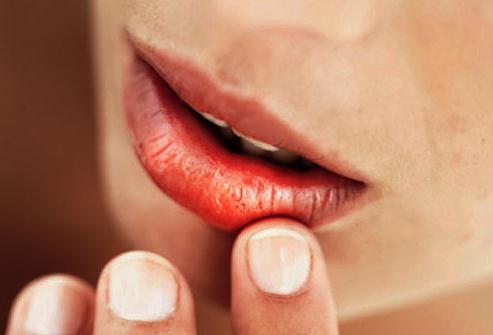 трещины в уголках губ