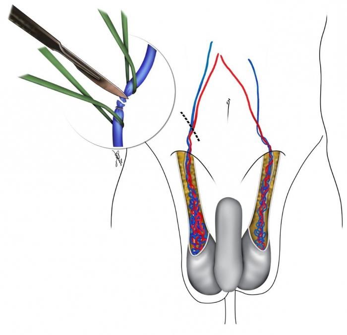 Сплетение яичка. Варикоз вен семенного канатика. Варикоцеле операция Мармара. Варикозное расширение вен семенного канатика яичка.. Шрам варикоцеле Мармара.