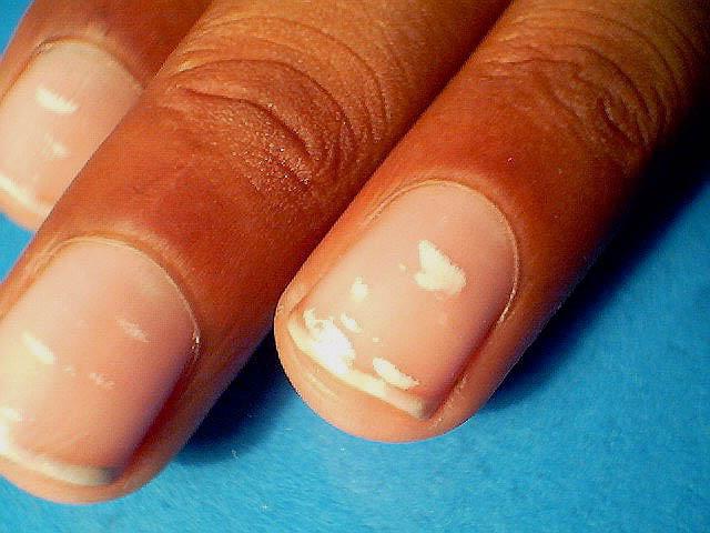 белое пятно на ногте