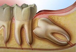 Удаление верхнего зуба мудрости