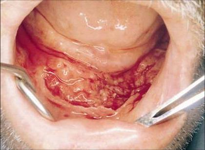как выглядит рак горла