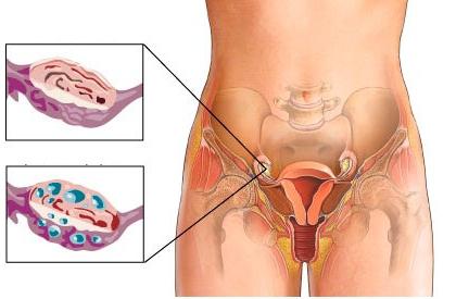 как болит яичник
