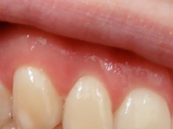 флюс после удаления зуба