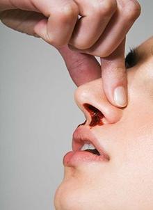 кровотечение из носа