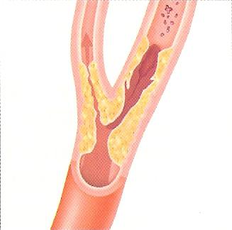 аневризма сонных артерий