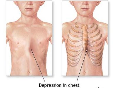 искривление грудной клетки