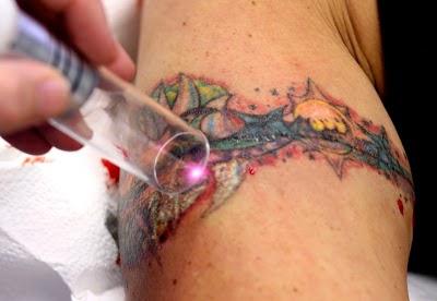 Удаление татуировок без шрамов
