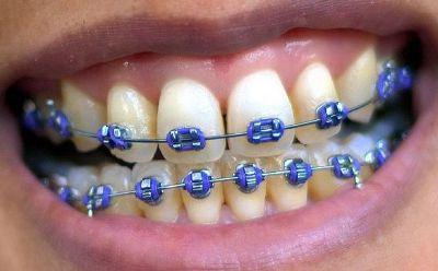 кривые зубы лечение