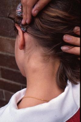 Воспаление лимфоузлов за ухом: причины, симптомы и лечение