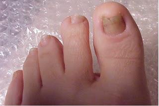 грибок ногтей лечение народным средствами