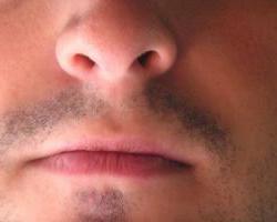 Стафилококк в носу симптомы