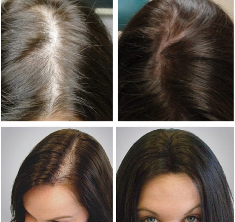 Уход за волосами при выпадении волос айрекоменд