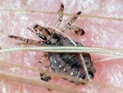 Как выглядят вши, и способы борьбы с ними