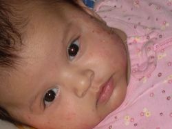 Стрептодермия у детей: виды, симптомы, лечение