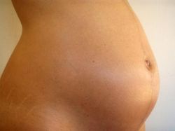 Растяжки при беременности: избавляемся вместе