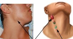 Увеличение лимфоузлов на шее: причины, симптомы, лечение
