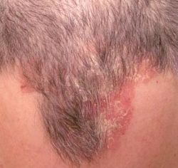 Себорея кожи головы: причины, формы и методы лечения 