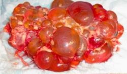 Поликистоз почек: симптомы и лечение
