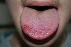 Жжение языка: что делать, как лечить и куда обратиться