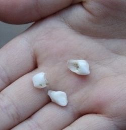 Сонник: зубы выпадают и крошатся от проблем