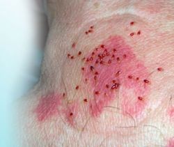 Постельные клещи как причина возникновения аллергии на пыль